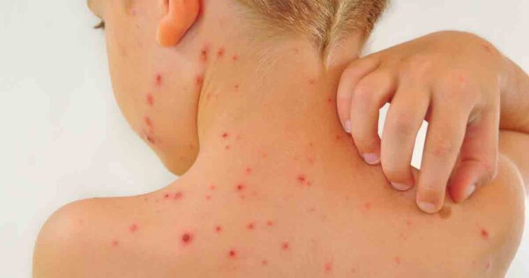 ಸಾಮಾನ್ಯವಾಗಿ ಮಕ್ಕಳಲ್ಲಿ ಕಂಡುಬರುವ ಸಿಡುಬು ರೋಗ 1 ಸಿಡುಬು