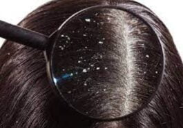 ತಲೆ ಹೊಟ್ಟಿನ ಸಮಸ್ಯೆ