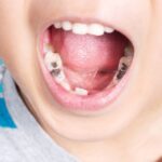 ಹುಳುಕು ಹಲ್ಲು