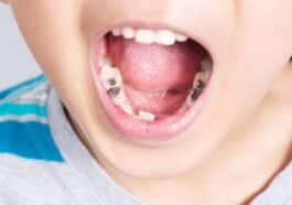 ಹುಳುಕು ಹಲ್ಲು