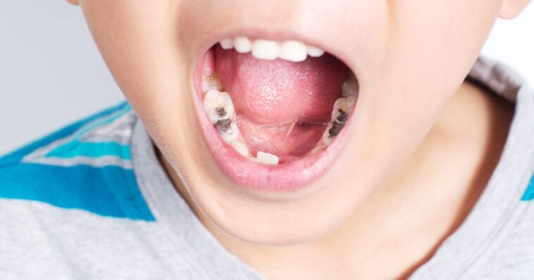 ಹುಳುಕು ಹಲ್ಲು