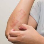 ಕೀಟಗಳ ಕಡಿತದಿಂದ ಆಗುವ ತೊಂದರೆ