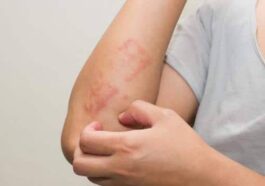 ಕೀಟಗಳ ಕಡಿತದಿಂದ ಆಗುವ ತೊಂದರೆ