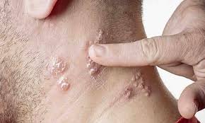 ಮಂಕಿಪಾಕ್ಸ್ ಕಾಯಿಲೆ