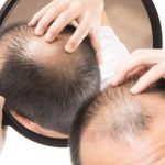 ಬೊಕ್ಕ ತಲೆಗೆ ಮನೆ ಮದ್ದು