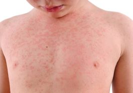 ಬೆವರುಸಾಲೆ