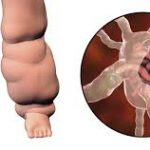 ಆನೆಕಾಲು ಕಾಯಿಲೆ