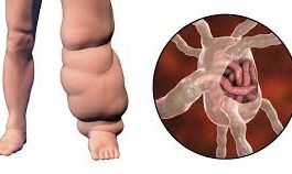 ಆನೆಕಾಲು ಕಾಯಿಲೆ