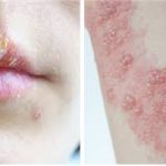 ಸರ್ಪ ಸುತ್ತು