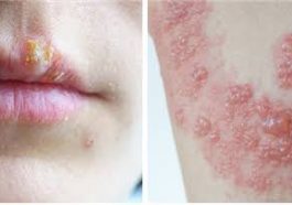 ಸರ್ಪ ಸುತ್ತು