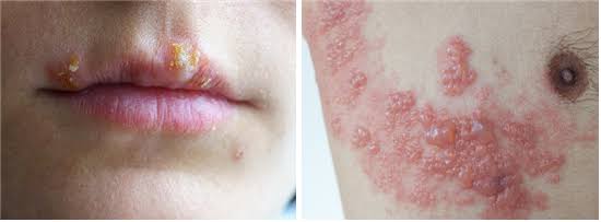 ಸರ್ಪ ಸುತ್ತು