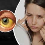 ಕಾಮಾಲೆ ರೋಗಲಕ್ಷಣ