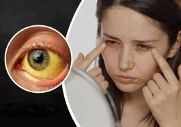 ಕಾಮಾಲೆ ರೋಗಲಕ್ಷಣ