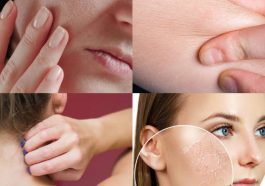 ಒಣ ಚರ್ಮಕ್ಕೆ ಸುಲಭ ಸಲಹೆಗಳು