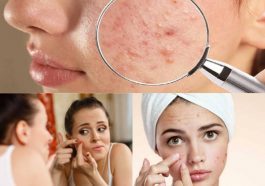 ಮೊಡವೆಗಳು ಬರುವ ಕಾರಣ