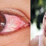 ಕರಾವಳಿಯ ಎಲ್ಲ ಕಡೆ ಕೆಂಗಣ್ಣು ಹುಷಾರು ಜಾಗೃತೆ ವಹಿಸಿ 27 ಕೆಂಗಣ್ಣು