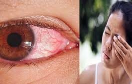 ಕೆಂಗಣ್ಣು