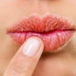 ಚಳಿಗಾಲದಲ್ಲಿ ತುಟಿಗಳು ಒಡೆಯುವುದು