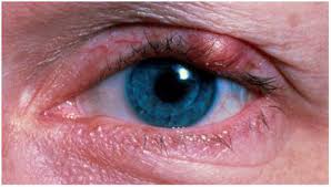 ಕಣ್ಣಿನಲ್ಲಿ ಕುರು