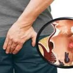 ಮೂಲವ್ಯಾಧಿ ಸಮಸ್ಯೆಗೆ ಮನೆಮದ್ದುಗಳು 28 ಮೂಲವ್ಯಾಧಿ ಸಮಸ್ಯೆಗೆ ಮನೆಮದ್ದು