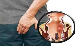 ಮೂಲವ್ಯಾಧಿ ಸಮಸ್ಯೆಗೆ ಮನೆಮದ್ದು