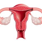 ಗರ್ಭಕೋಶದ ಆರೋಗ್ಯಕ್ಕೆ ಹಲವಾರು ಪರಿಹಾರಗಳು 27 ಗರ್ಭಕೋಶದ ಆರೋಗ್ಯಕ್ಕೆ ಹಲವಾರು ಪರಿಹಾರ