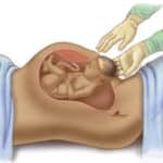 ಸಿ-ಸೆಕ್ಷನ್ ಅಂದರೆ ಸಿಸೇರಿಯನ್ ಹೆರಿಗೆಯ ನಂತರದ ಆರೈಕೆ ಹೇಗೆ? 28 ಸಿಸೇರಿಯನ್ ಹೆರಿಗೆಯ ನಂತರದ ಆರೈಕೆ