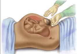 ಸಿಸೇರಿಯನ್ ಹೆರಿಗೆಯ ನಂತರದ ಆರೈಕೆ